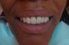 after invisalign
