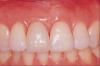AFTER: Missing tooth restored with implant and crown
