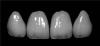 porceoain veneers black and white