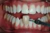 1hour power bleaching whitening sofia bulgaria cosmetic dentist
